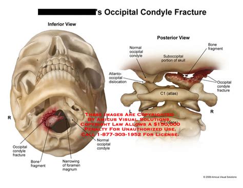 AMICUS Illustration of amicus,injury,fracture,condyle,occipital,bone,fragment,foramen,magnum ...