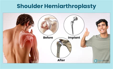 Shoulder Hemiarthroplasty - Procedure and Side Effects