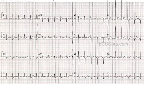 ECG Interpretation: ECG Interpretation Review #72 (Sinus Tachycardia in a Child - Juvenile T ...