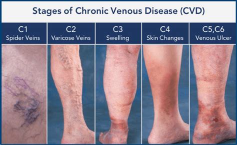 Varicose Veins Treatment In Florida - Vascular Health Center