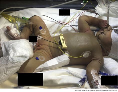 Bronze baby syndrome or early onset sepsis? | Anales de Pediatría