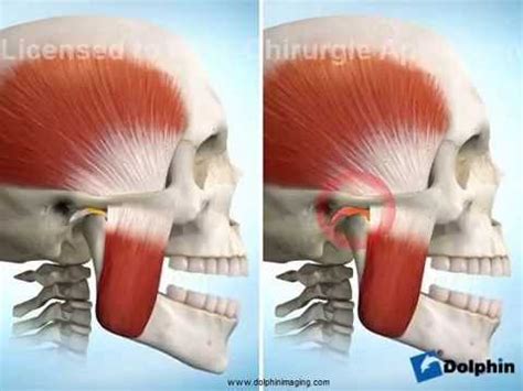 TMJ Anterior Disc Displacement - YouTube