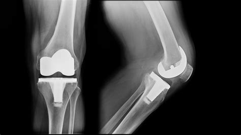 Looking for knee replacement alternatives?