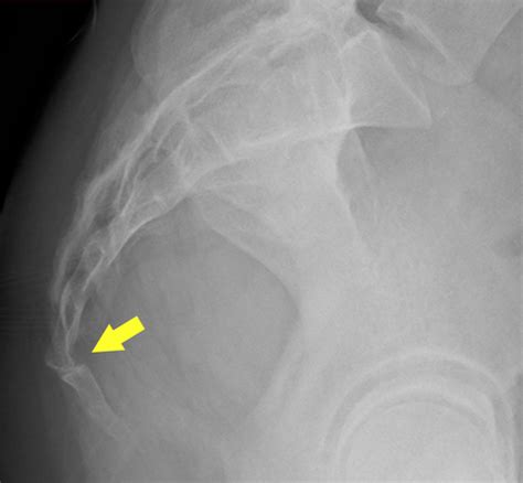 Coccyx Fracture Treatment