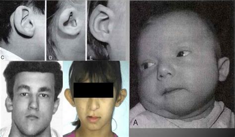 Velocardiofacial syndrome causes, symptoms, diagnosis & treatment