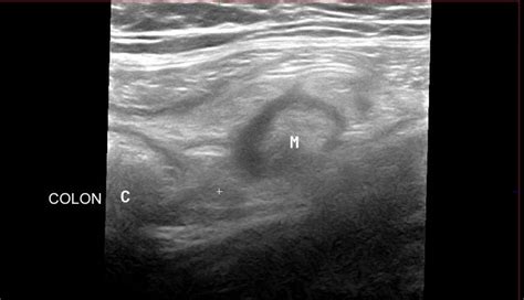 Epiploic appendagitis-Ultrasound - Sumer's Radiology Blog