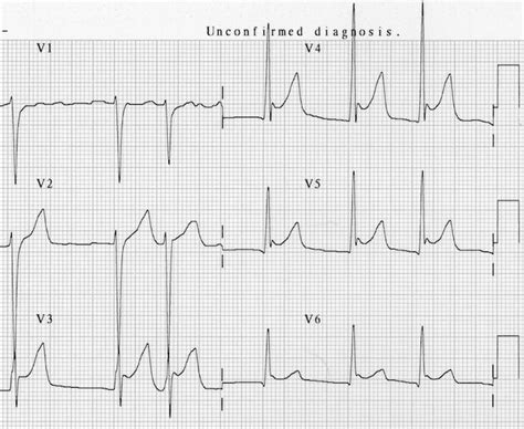 Osborn Wave (J Wave) • LITFL Medical Blog • ECG Library Basics | Ecg ...