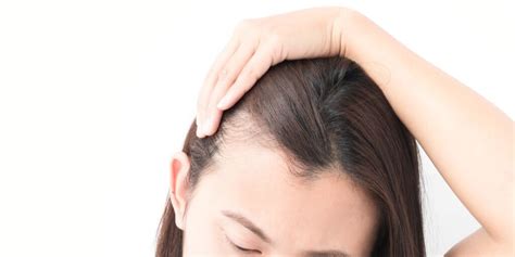 How to treat Hair Loss on Temples in 6 Simple ways - Superloudmouth