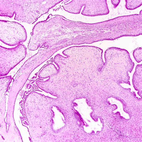 Pathology Outlines - Phyllodes tumor