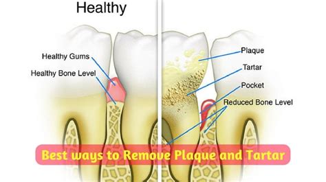 7 Best ways to Remove Plaque and Tartar