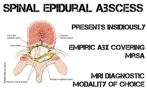 Spinal Epidural Abscess (SEA) - REBEL EM - Emergency Medicine Blog