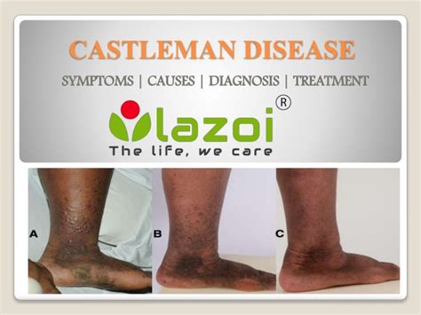 Castleman Disease : Symptoms, causes, diagnosis and treatment