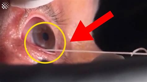 15cm Parasitic Worm Removed From Man's Eye - YouTube