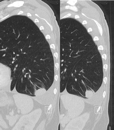 Round atelectasis | Radiology Case | Radiopaedia.org