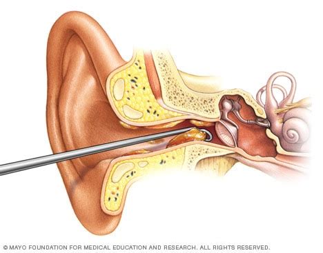 Earwax blockage - Diagnosis and treatment - Mayo Clinic