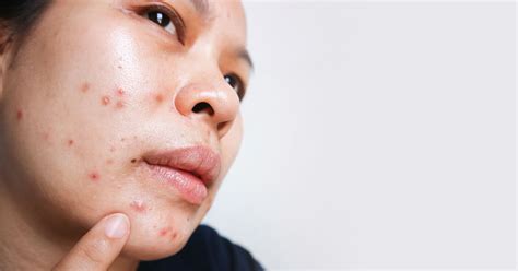 How To Treat Acne Around the Mouth (And the Reasons You’re Breaking Out ...