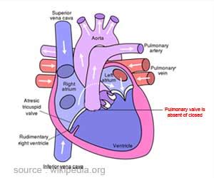 Pulmonary Atresia - Types, Symptoms, Diagnosis and Management