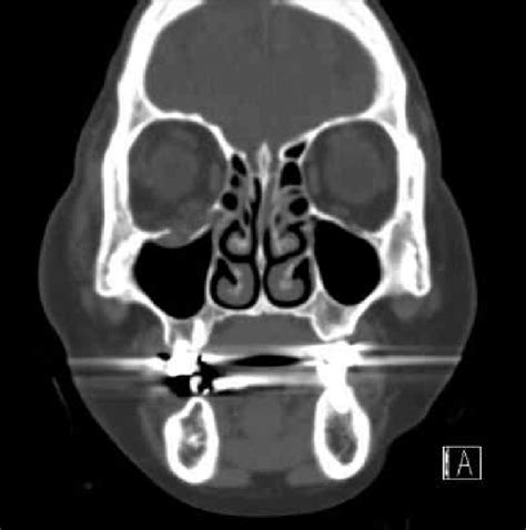 The CT scan coronal image of the patient with inferior orbital wall... | Download Scientific Diagram