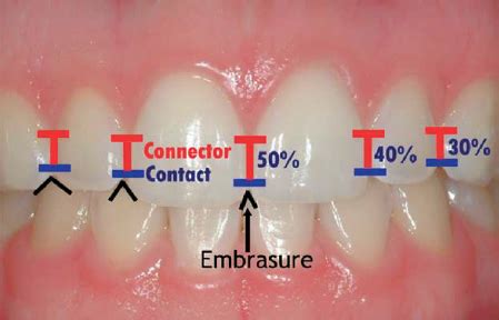 Ideal maxillary central incisor proportion is approximately 80% width... | Download Scientific ...