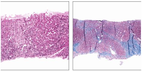 Focal Nodular Hyperplasia | Basicmedical Key