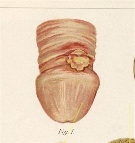 Antique syphilis print. Medical illustration. STD. Chancre. | Etsy