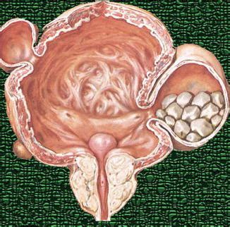 Diagnostic Imaging of Urinary Bladder Diverticula | Radiology Key