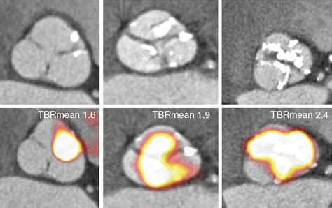 Aortic stenosis and bioprosthetic valve degeneration | Radiology Key