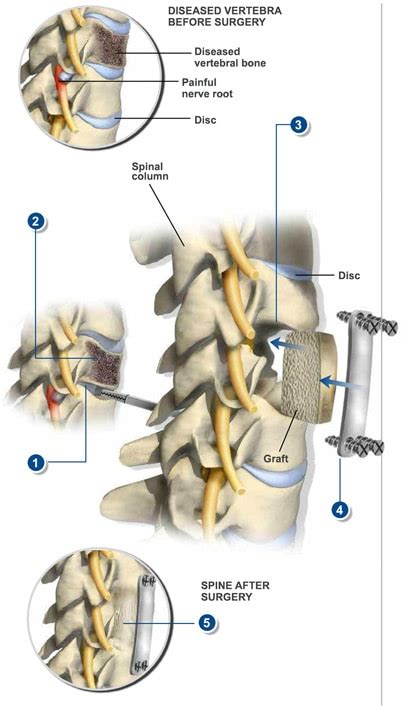 Anterior Cervical Corpectomy - The Southeastern Spine Institute