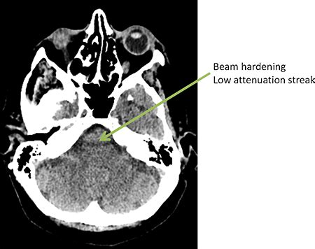 CT artefacts - Radiology Cafe