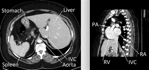 CT scan image of the great vessels showing that the main pulmonary ...