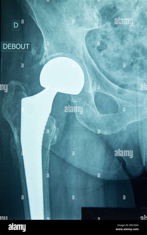 Hip prosthesis, surgery Stock Photo - Alamy