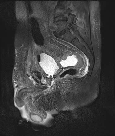 Vesicocutaneous fistula | Image | Radiopaedia.org