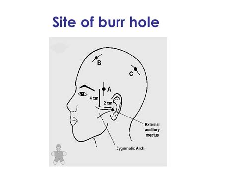 Burr Hole