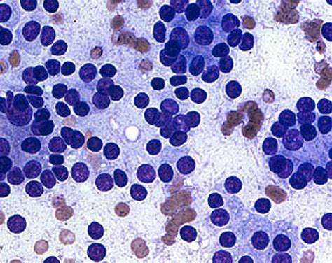 Pathology Outlines - Follicular neoplasm