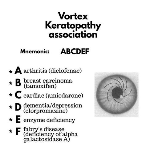 Vortex Keratopathy... - Ophthalmology-Notes And Synopses | Facebook