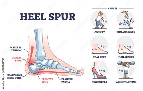 Heel spur problem or calcaneal bone condition causing pain in feet ...