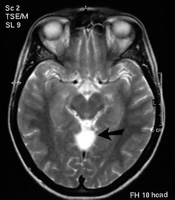 USA Cancer Information: Superior cerebellar cistern arachnoid cyst (Brain cyst) | USA Cancer ...