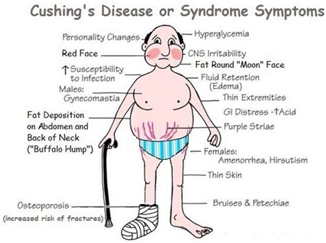 Cushing syndrome Pictures | Medical Pictures and Images - (2023 Updated)