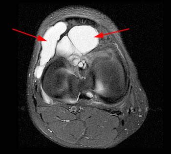 Radiology Pearls: Infrapatellar (Hoffa's fat pad) ganglion cyst