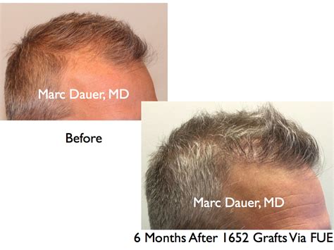 FUE Hair Transplant Results and Donor Zone After 6 Months | Marc Dauer ...