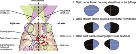 [Solved] Draw a diagram showing how a tumor pressing on the optic chiasm... | Course Hero