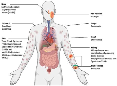 Infections caused by Staphylococcus aureus | Download Scientific Diagram