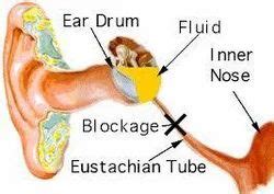 Glue Ear Treatment in Varanasi by Satkriti ENT Hospital | ID: 10151679055