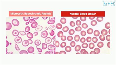 hypochromic microcytic anemia dx – causes of microcytic hypochromic ...