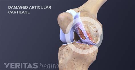 Knee Cartilage Repair, Regeneration, and Replacement