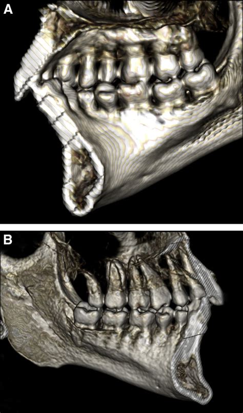 Blending of the occlusal surfaces and loss of occlusal details of the... | Download Scientific ...