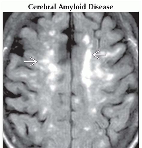 Multiple Brain Hyperintensities (T2/FLAIR), Less Common | Neupsy Key