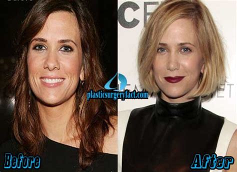 Kristen Wiig Plastic Surgery: Nose Job - Plastic Surgery Facts