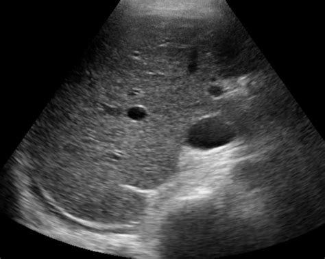 Liver Atlas: Diagnosis: Cirrhosis