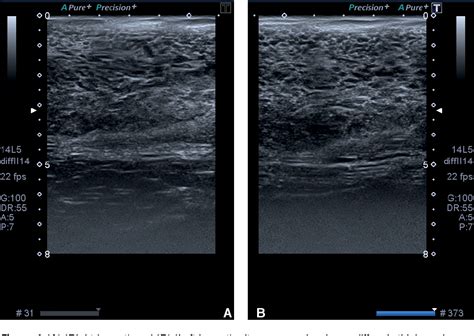 Figure 1 from Juvenile Breast Hypertrophy: Report of two cases presenting with Massive ...